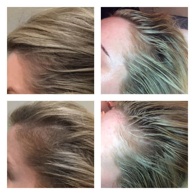 Before and after hair loss treatment results in Los Angeles 90045
