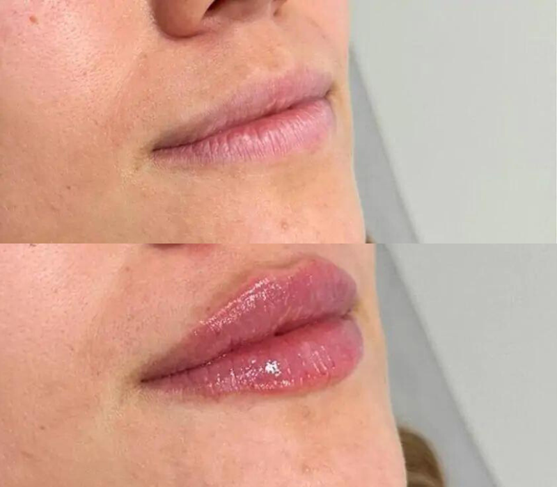 Lip filler before and after results in Westchester Los Angeles