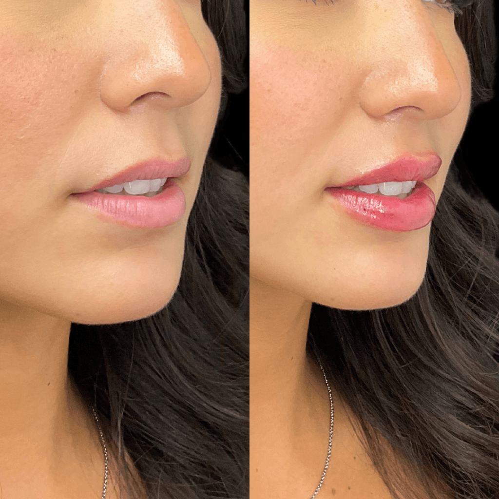 Lip filler before and after results in Los Angeles 90045