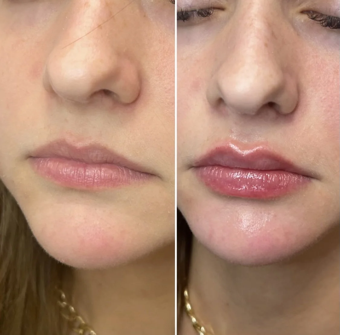 Botox lip flip before and after results in Los Angeles 90045