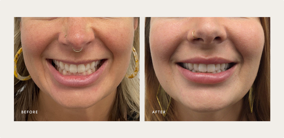 Botox lip flip gummy smile before and after near Marina del Rey Los Angeles