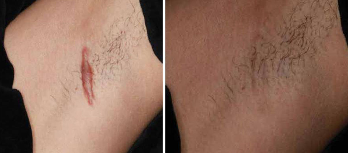 Lumenis IPL before and after results for facial skin in Westchester Los Angeles