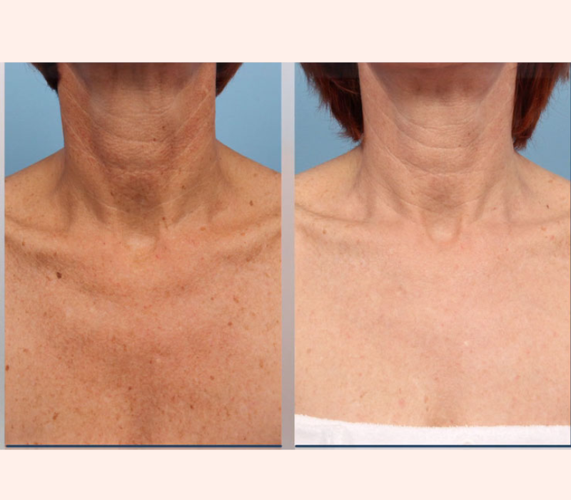 Lumenis IPL before and after results for neck skin near Playa Vista