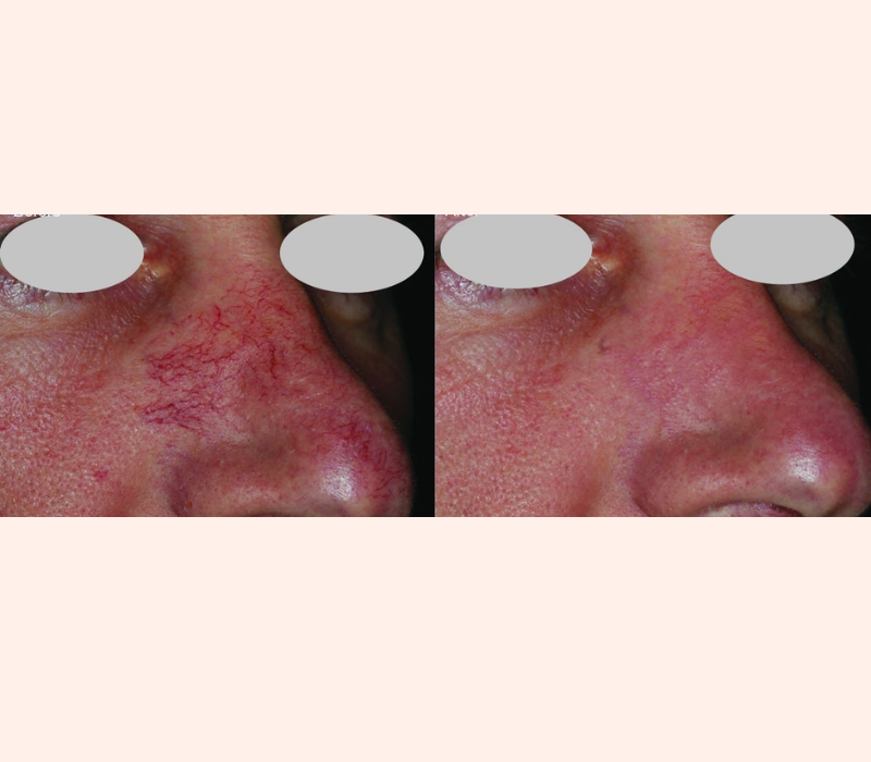 Lumenis IPL before and after results for rosacea in Los Angeles 90045