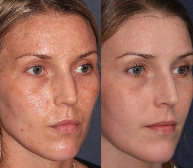 Lumenis IPL before and after results for acne near Marina del Rey