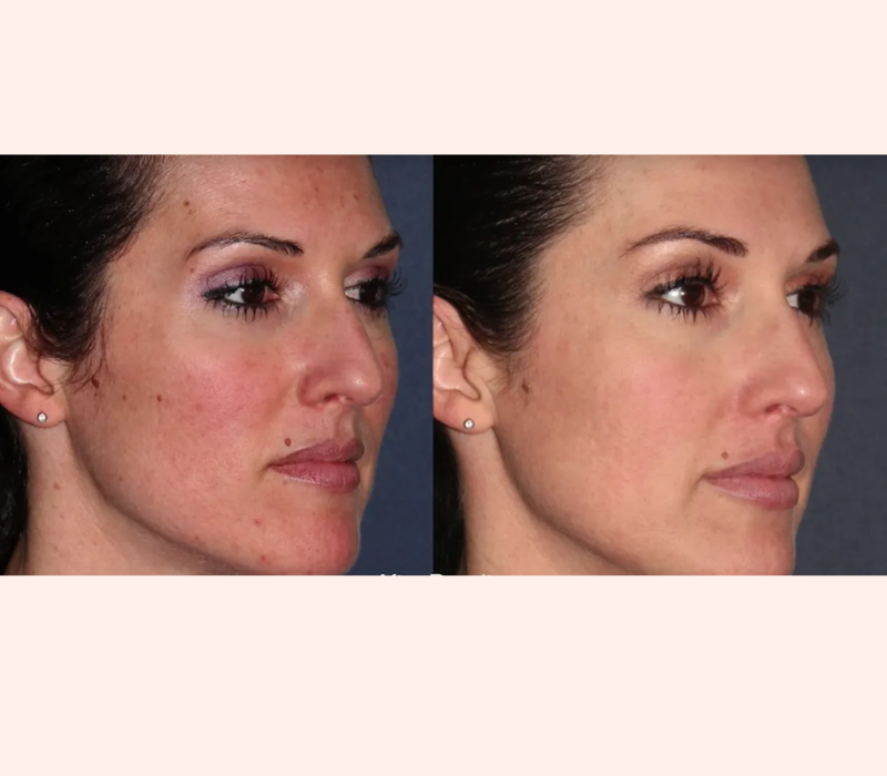 Lumenis IPL before and after results for skin tone at Total Body Aesthetic med spa Los Angeles