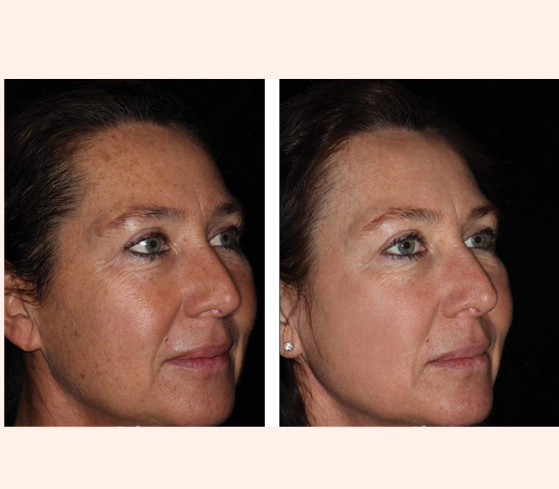Lumenis IPL before and after results for sun damage in Westchester Los Angeles