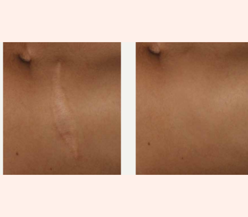Lumenis IPL before and after results for acne scars near Playa Vista