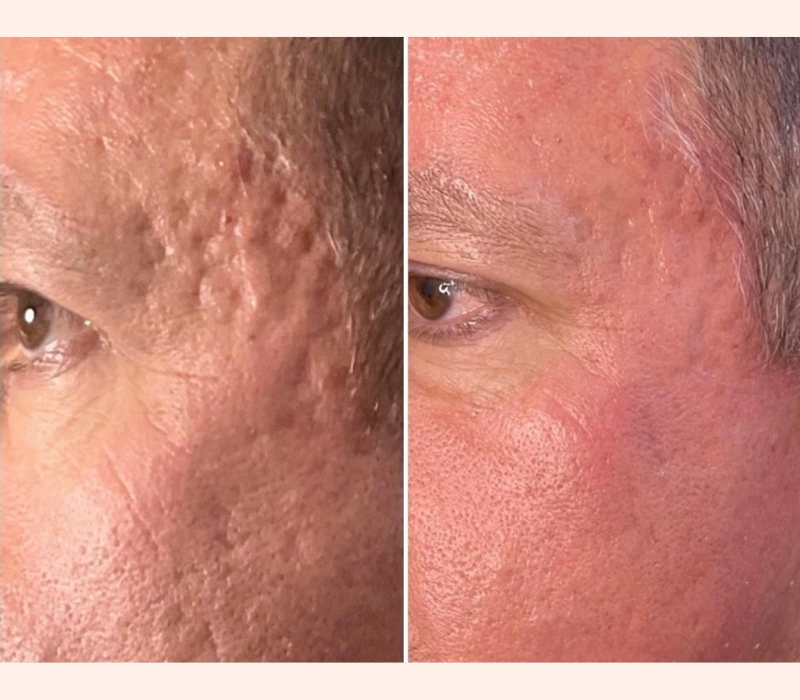 Lumenis IPL before and after results for skin texture in Los Angeles 90045