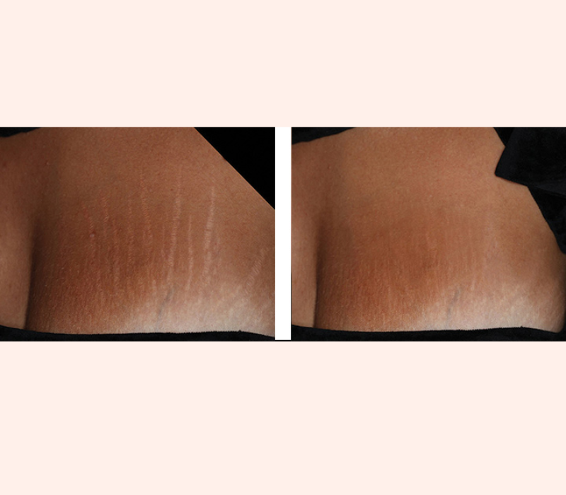 Lumenis IPL before and after results for stretch marks near Marina del Rey