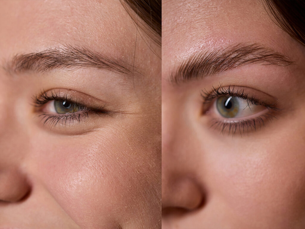 PRF microneedling before and after near Marina del Rey