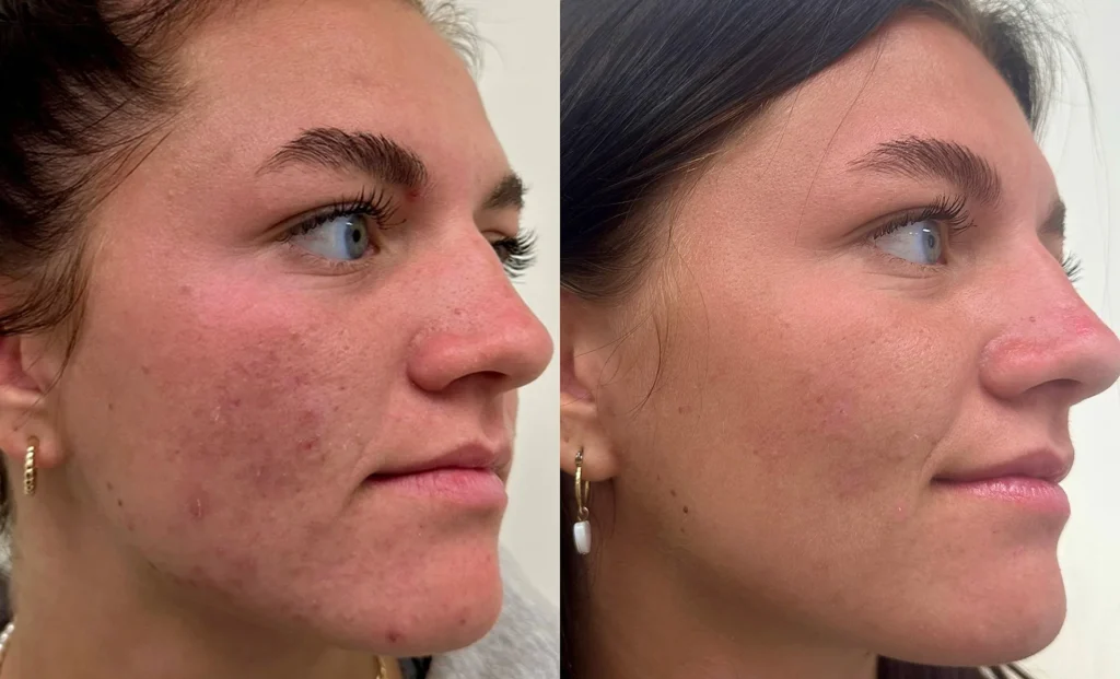 Microneedling acne scarring before and after results in Los Angeles 90045