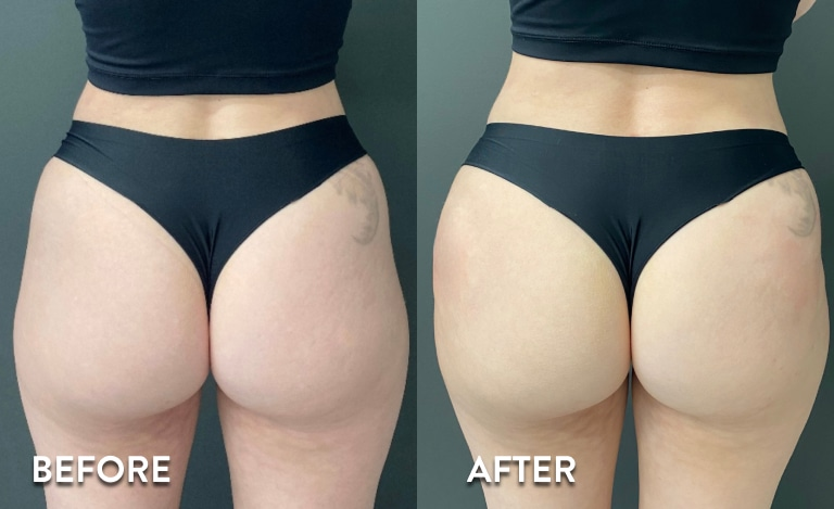 Non-surgical BBL before and after body contouring results in Westchester Los Angeles