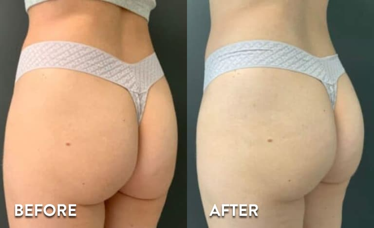 Non-surgical BBL before and after results in Los Angeles 90045