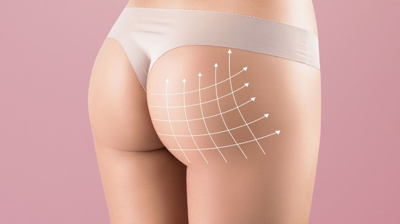 Sculpted silhouette after nonsurgical BBL body contouring at Total Body Aesthetic Westchester Los Angeles 90045