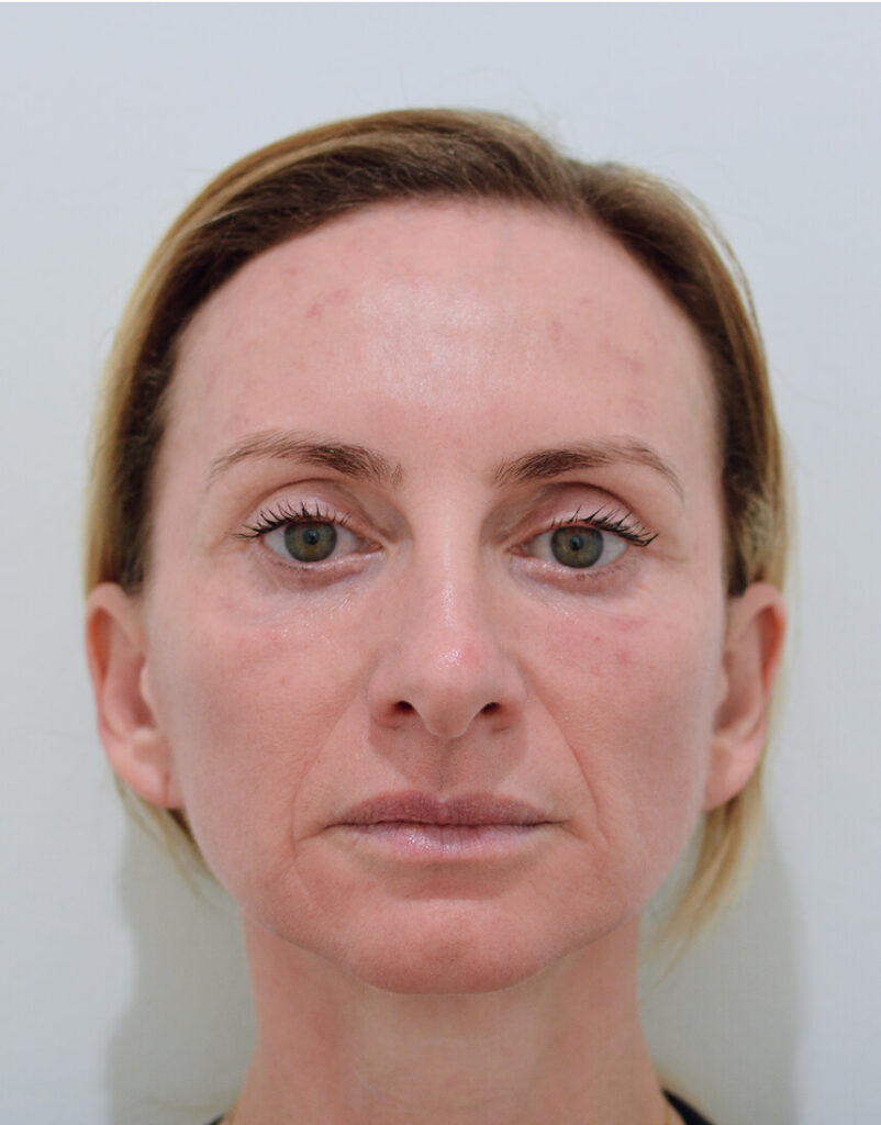 PDGF facial rejuvenation results 1 day after treatment in Los Angeles 90045