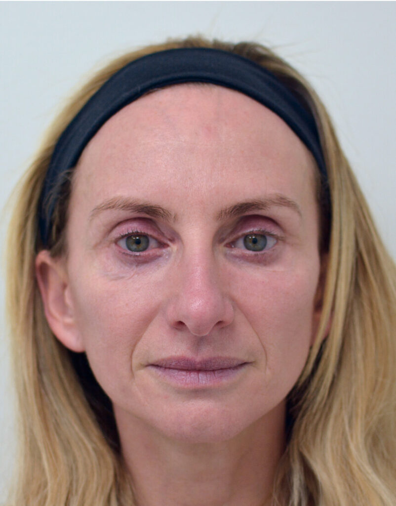 PDGF facial rejuvenation before treatment in Westchester Los Angeles