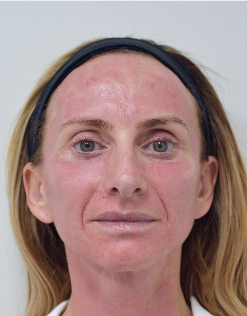 PDGF facial rejuvenation immediately after treatment near Playa Vista