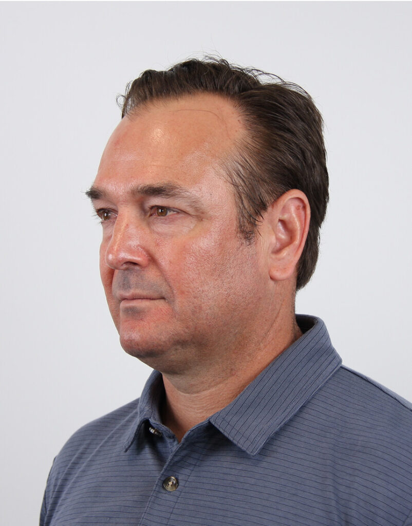 PDGF facial 1 hour post-microneedling near Playa Vista