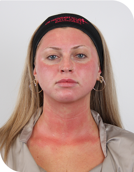 PDGF facial immediately post-microneedling in Westchester Los Angeles