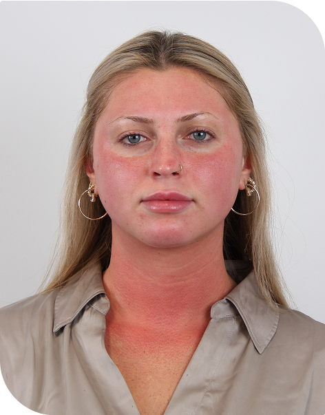 PDGF facial 1 hour post-microneedling near Playa Vista