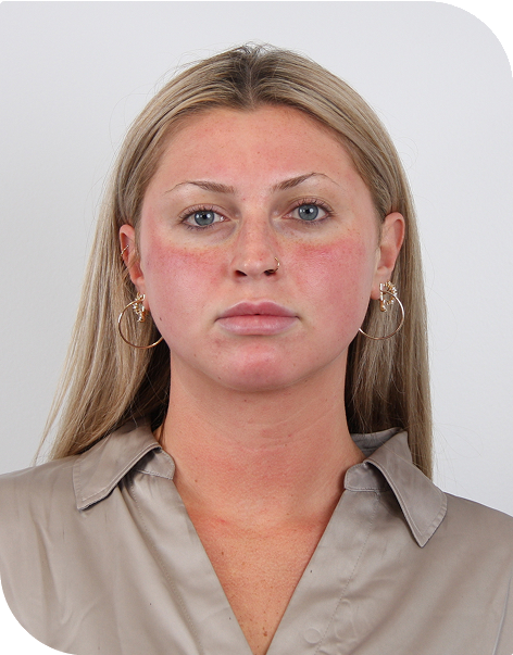 PDGF facial 3 hours post-microneedling in Los Angeles 90045