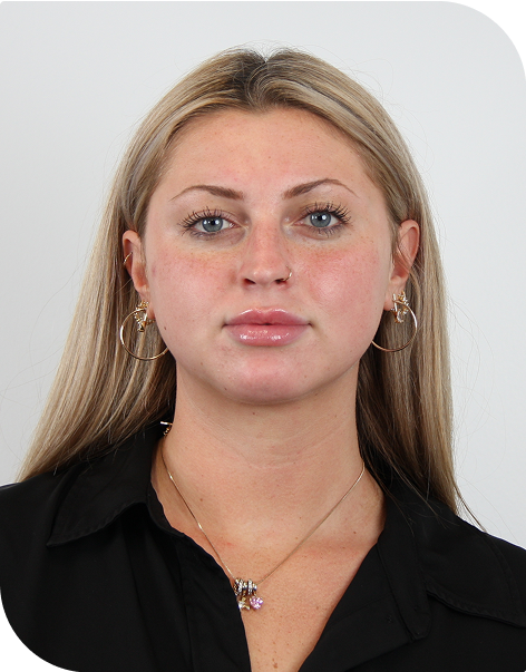 PDGF facial 1 day post-microneedling results near Marina del Rey