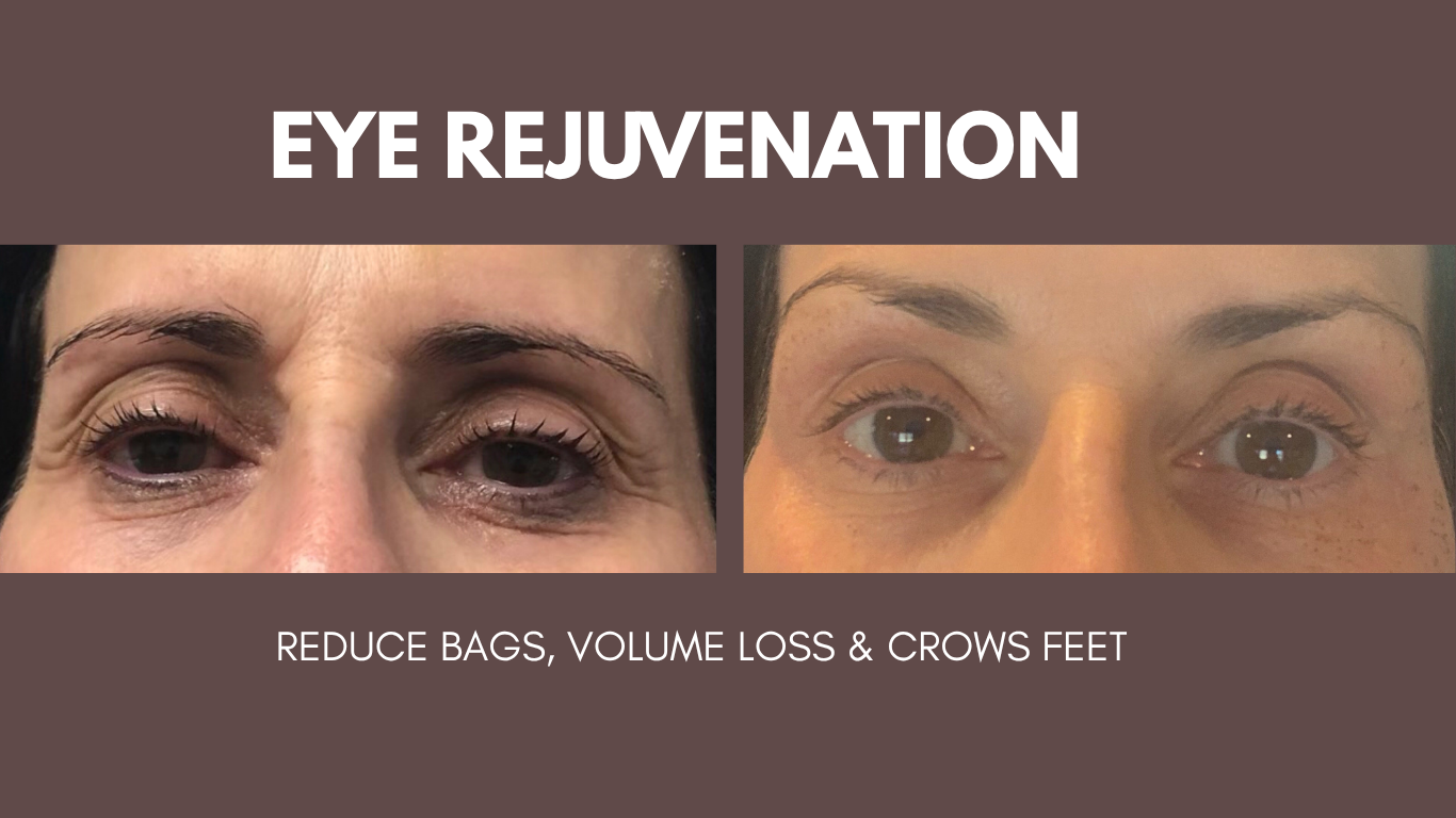 Supplied Eye Rejuvenation comparison graphic showing the eye area, with original text reading Reduce bags, volume loss and crow's feet