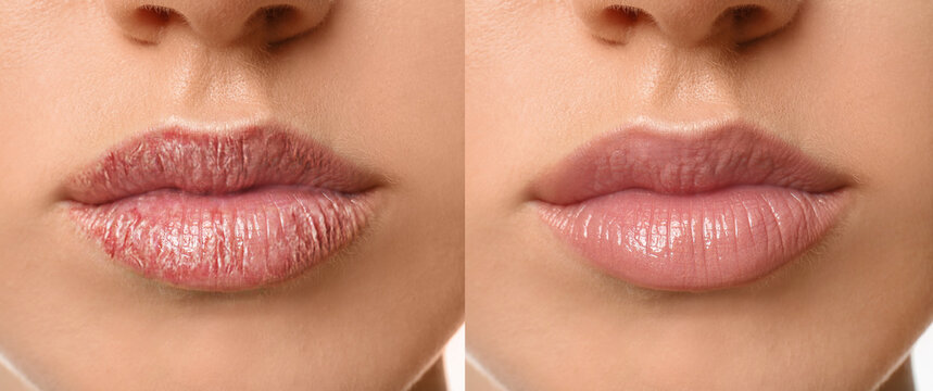 Lips before and after SkinVive, smoother and hydrated in Los Angeles 90045