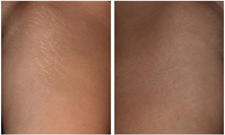 Stretch mark treatment before and after comparison