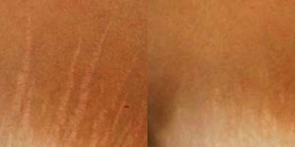 Stretch mark reduction before and after comparison