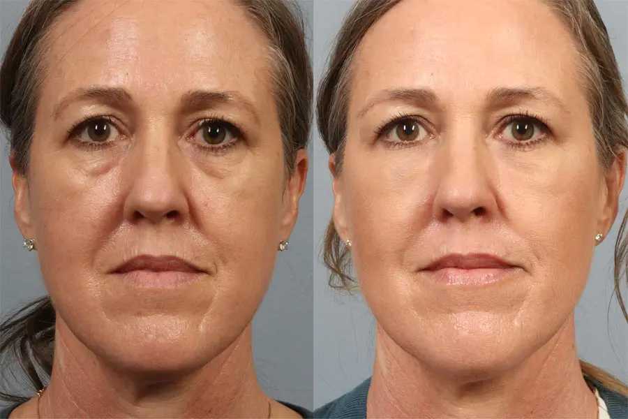 Sylfirm X before and after facial rejuvenation results near Marina del Rey