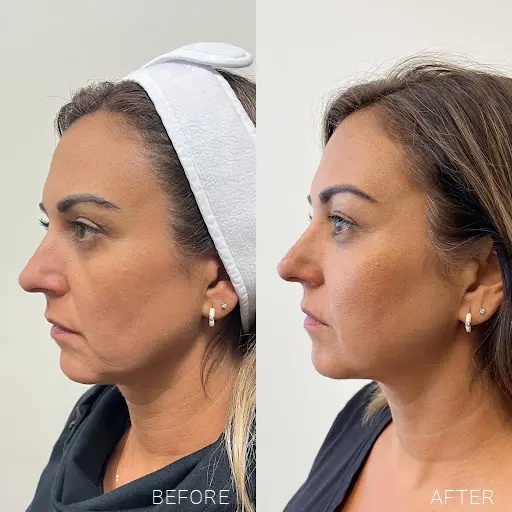 Sylfirm X before and after skin tightening results in Los Angeles 90045