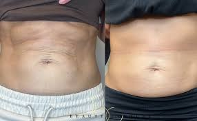 Sylfirm X before and after body treatment results near Playa Vista