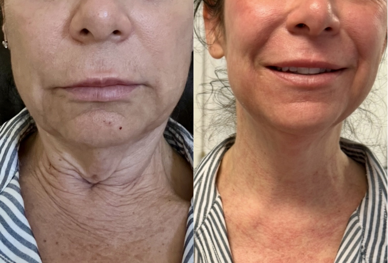 Sylfirm X before and after neck tightening results in Westchester Los Angeles