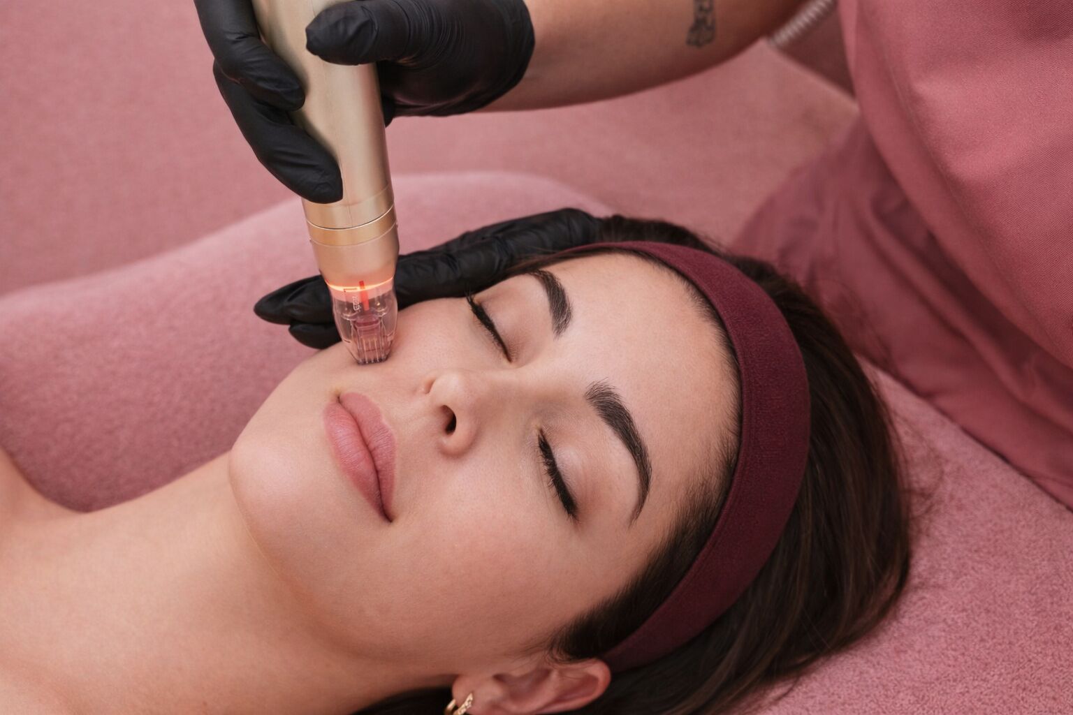 Even glowing skin tone after Sylfirm X melasma treatment at Total Body Aesthetic Westchester Los Angeles 90045
