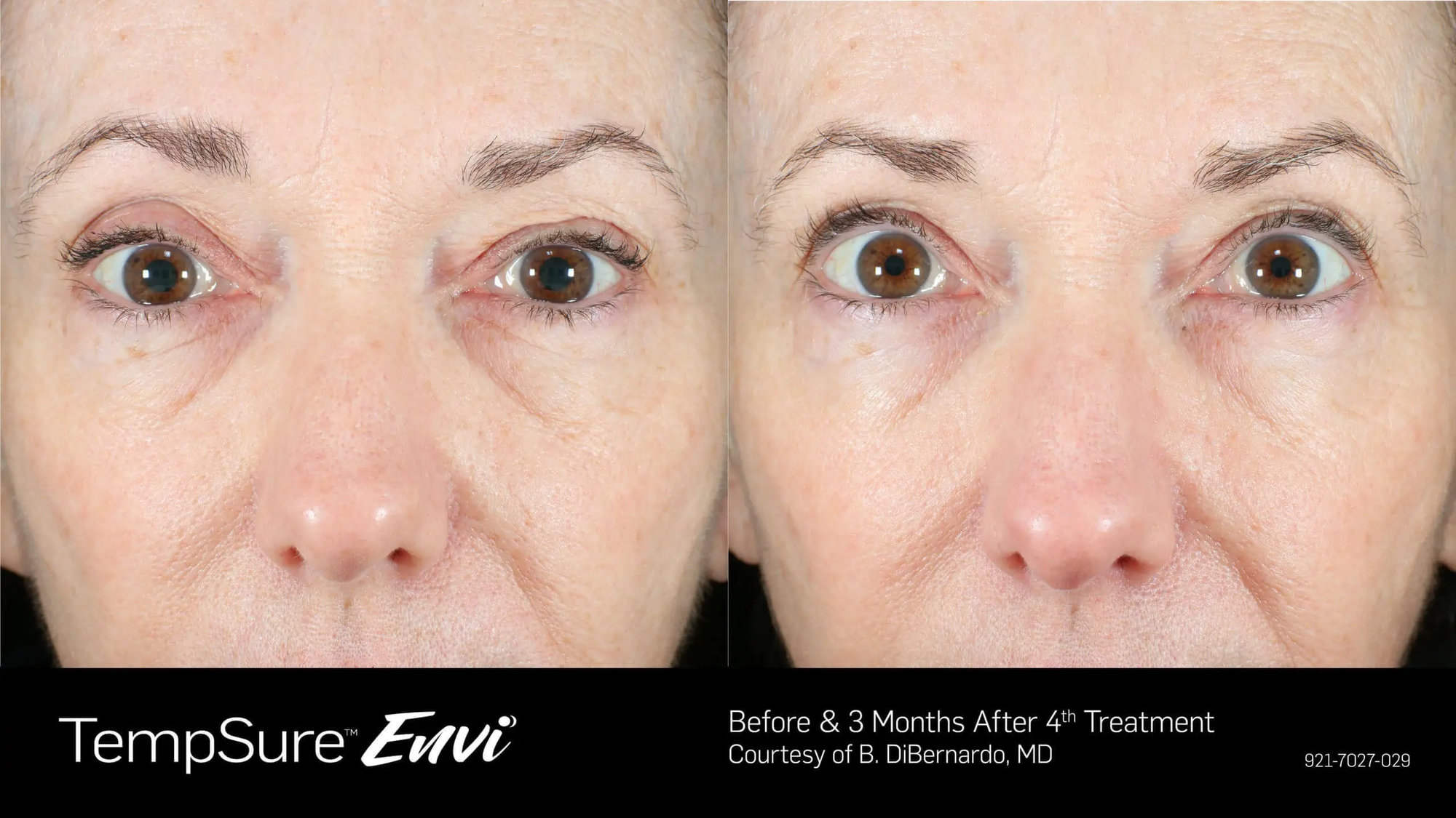 Before and after TempSure Envi treatment results near Playa Vista