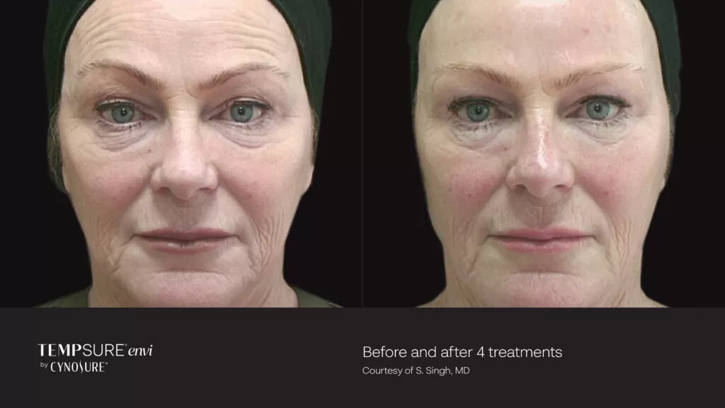 Before and after TempSure Envi 4 treatments results in Los Angeles 90045