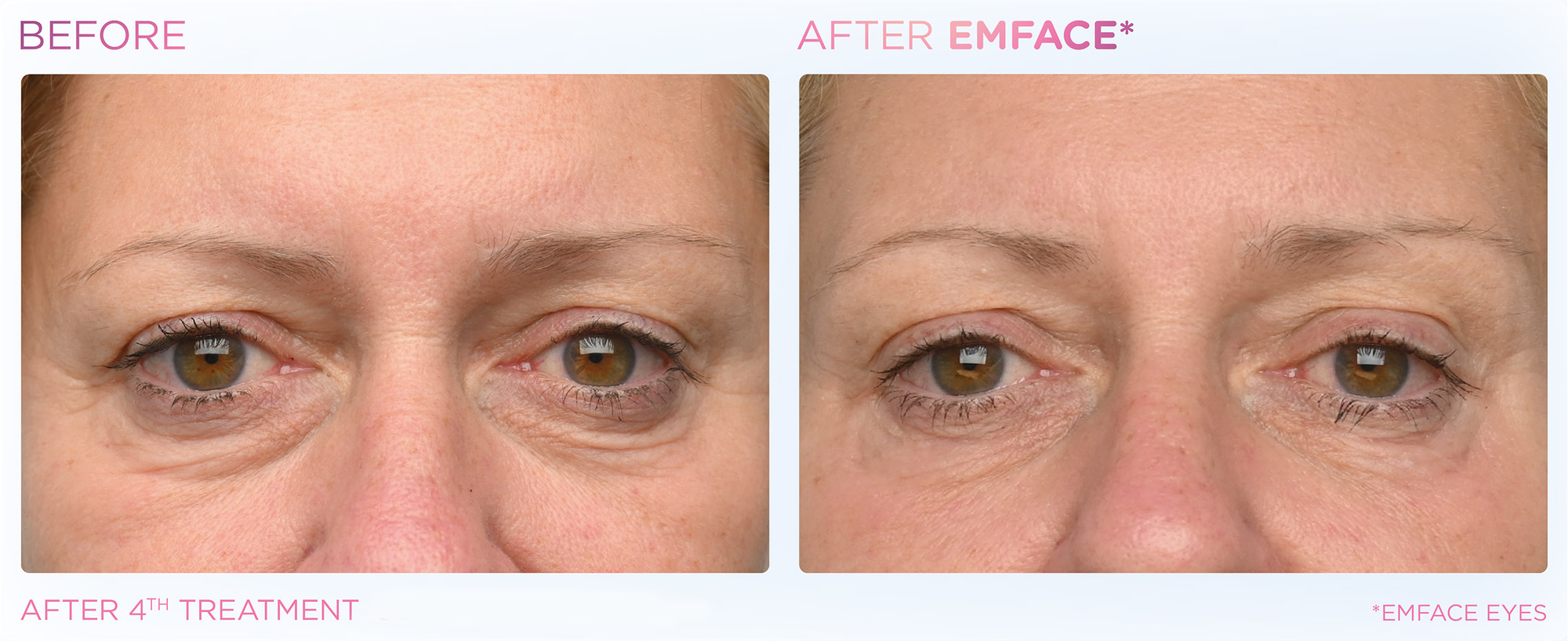 Emface under eye before and after results near Playa Vista