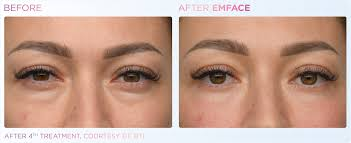 Emface under eye before and after results in Los Angeles 90045