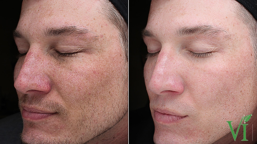 VI Peel before and after acne treatment results Los Angeles