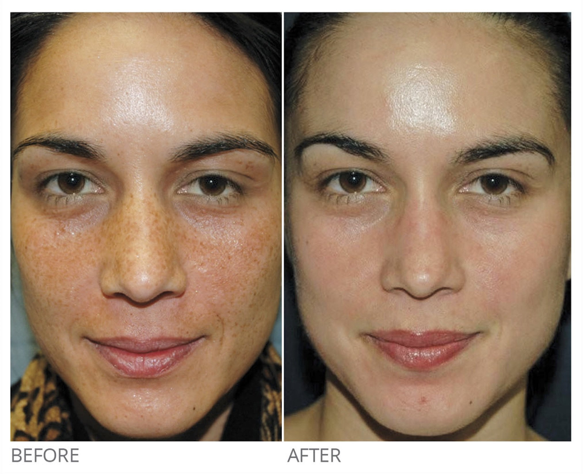 VI Peel before and after skin improvement results Los Angeles